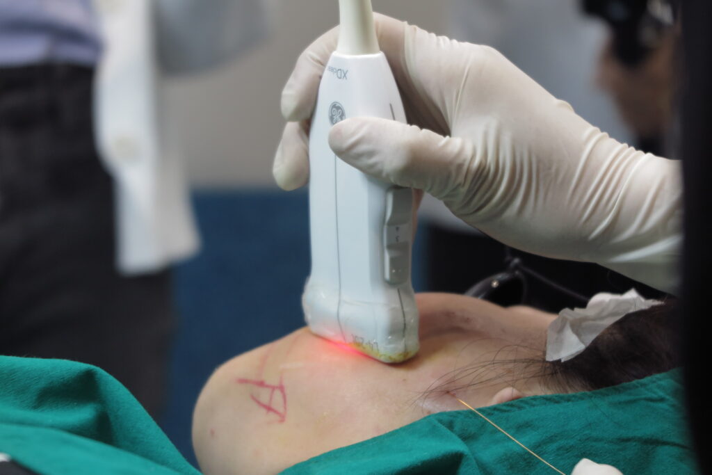 EndoliftX with Facial Ultrasound in Thailand - 1