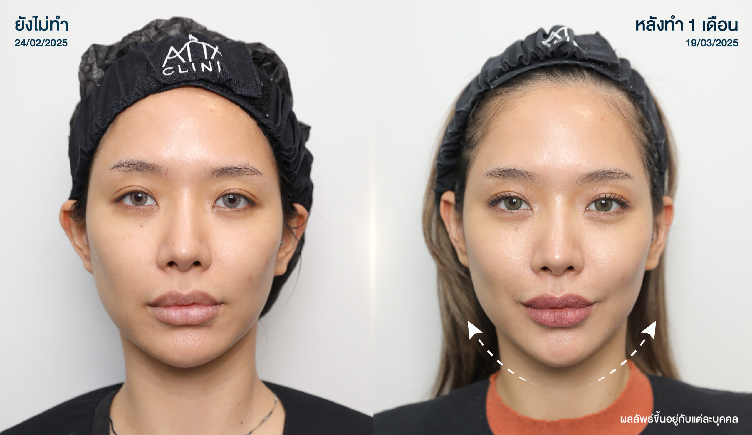 โปรแกรม ฟิลเลอร์ ฉีดฟิลเลอร์ อัลตราซาวนด์ (2)