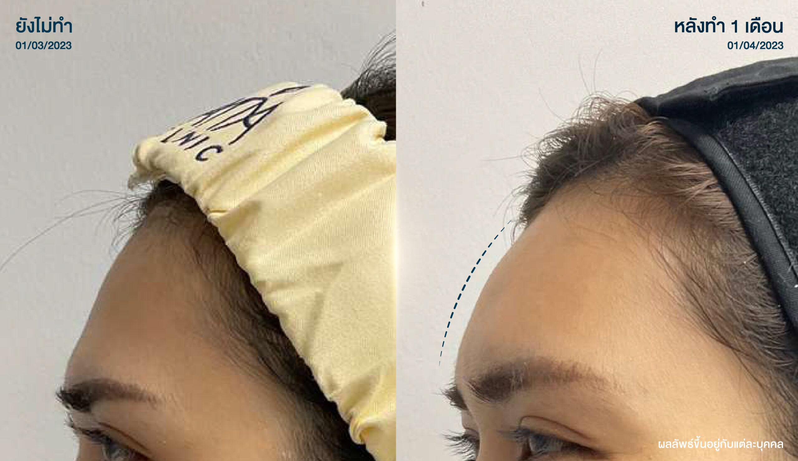 โปรแกรม ฟิลเลอร์ ฉีดฟิลเลอร์ อัลตราซาวนด์ (3)