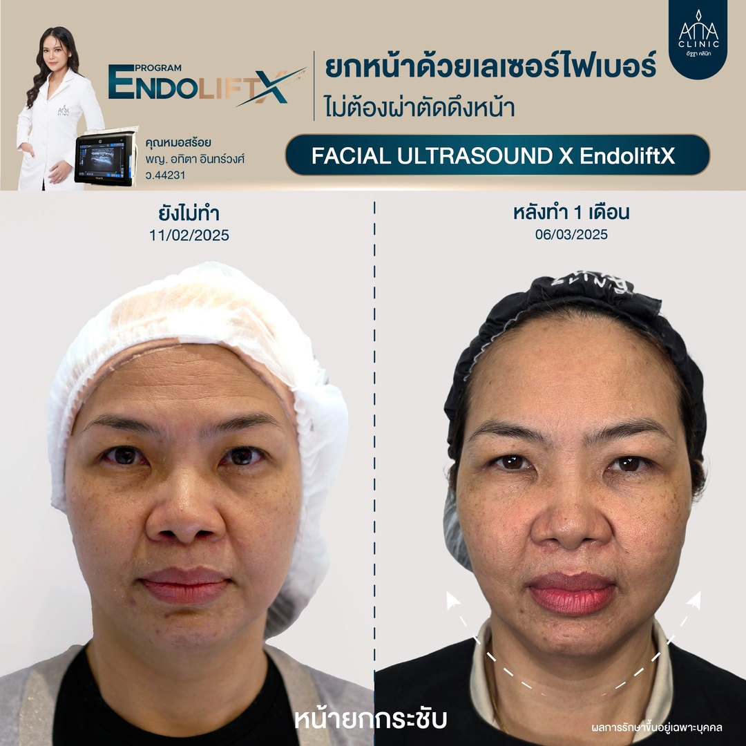 เอ็นโดลิฟท์ Endolift X ยกหน้าไม่ผ่าตัด ยกหน้าด้วยเลเซอร์ ยกกระชับ3.jpg