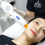 5-misconceptions-ultherapy-face-lifting-01