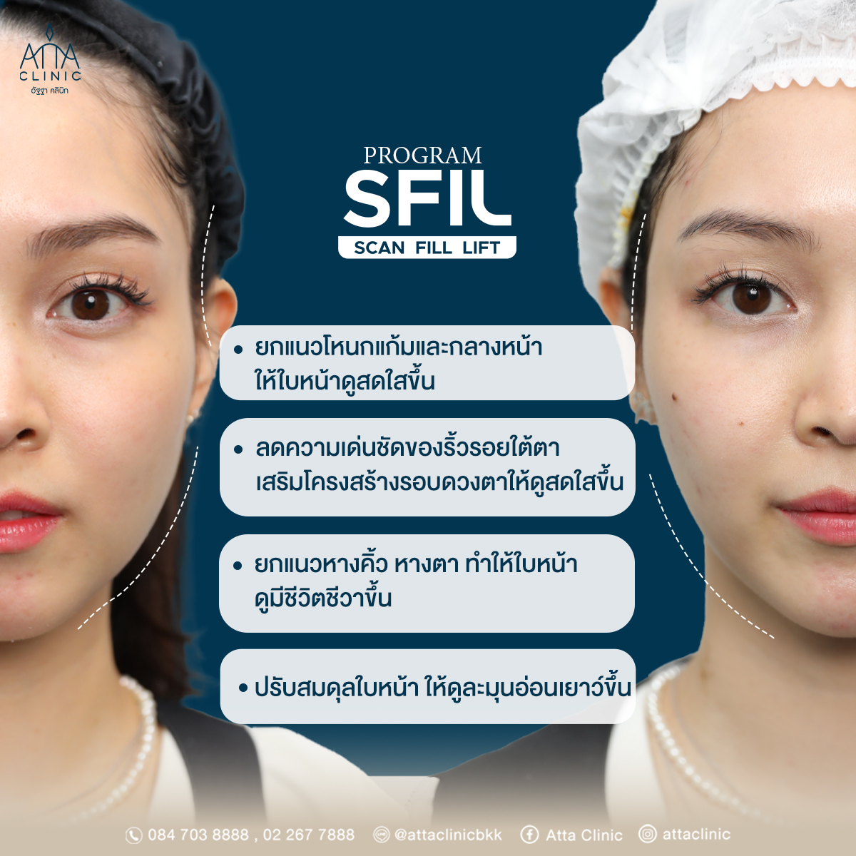 SFIL PROGRAM โปรแกรมฉีดฟิลเลอร์แบบสแกนเห็น เพิ่มความแม่นยำ ลดความเสี่ยง