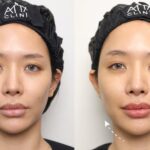 how-long-does-filler-last-00004