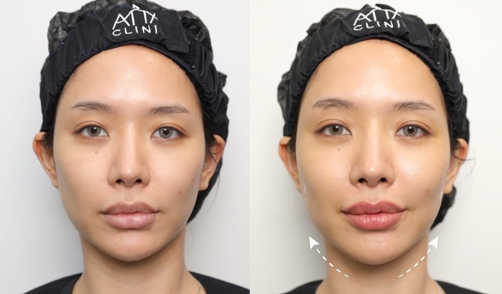 how-long-does-filler-last-00004