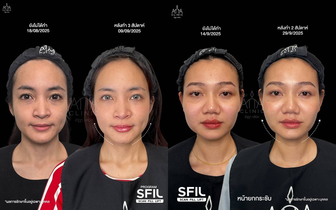 รีวิวฉีดฟิลเลอร์หน้า