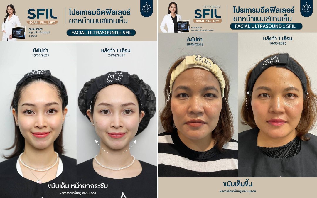 รีวิวฉีดฟิลเลอร์ขมับ ฟิลเลอร์ยกกระชับหน้า