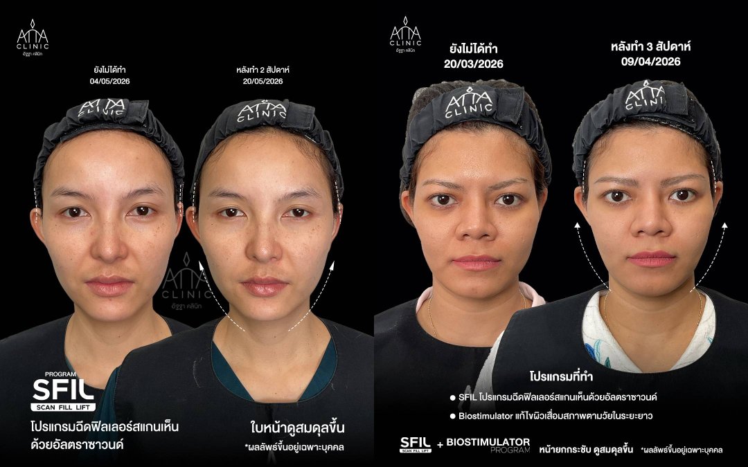 รีวิวโปรแกรมฉีดฟิลเลอร์หน้า