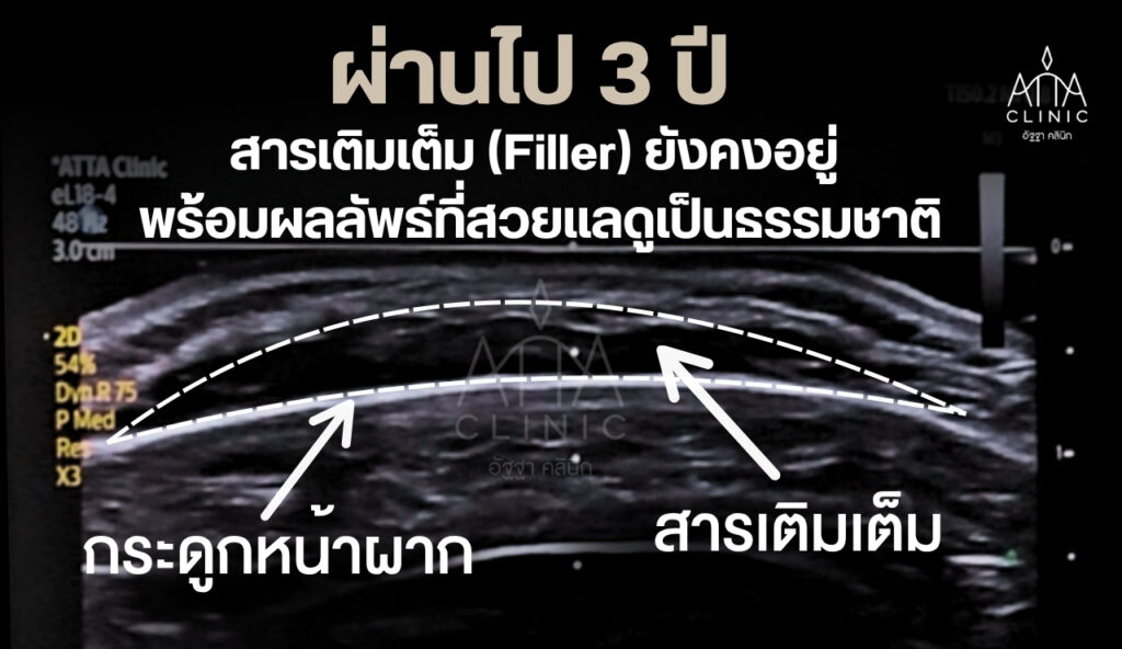 2.2