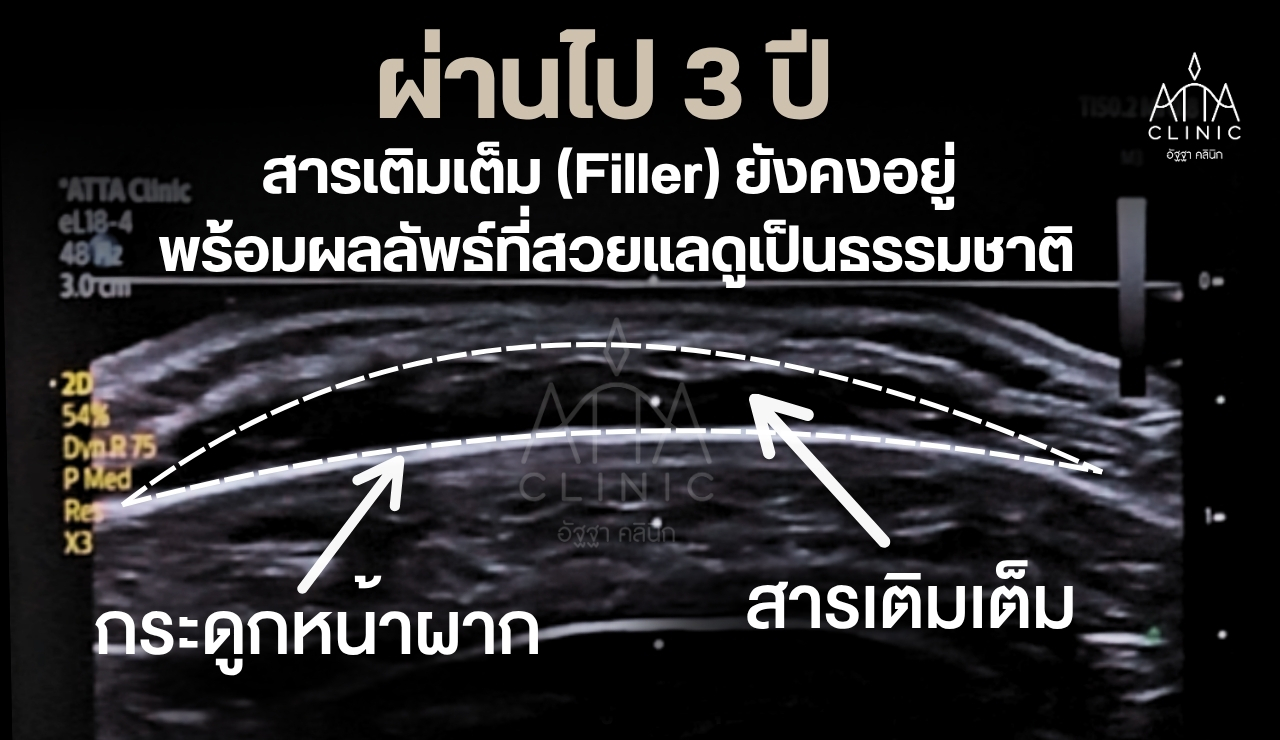 2.2