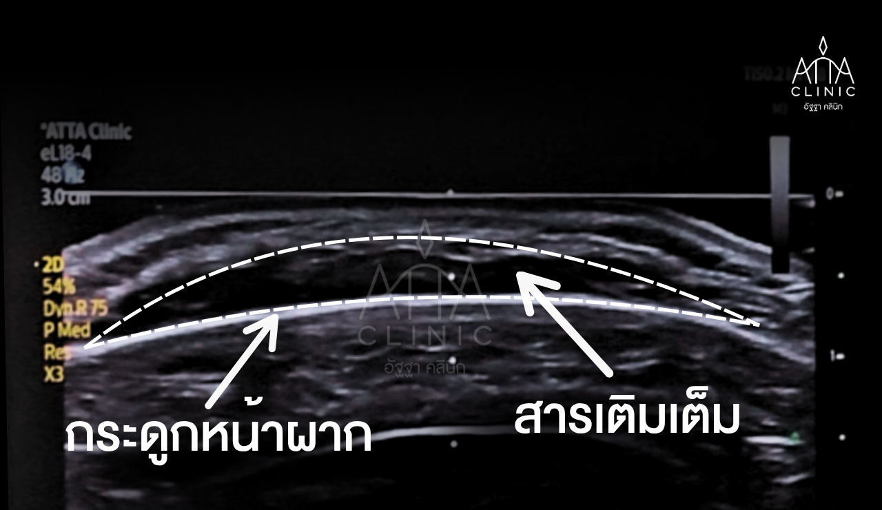 รูปคุณเพ็ง ผลลัพธ์ (1280 x 740 px)