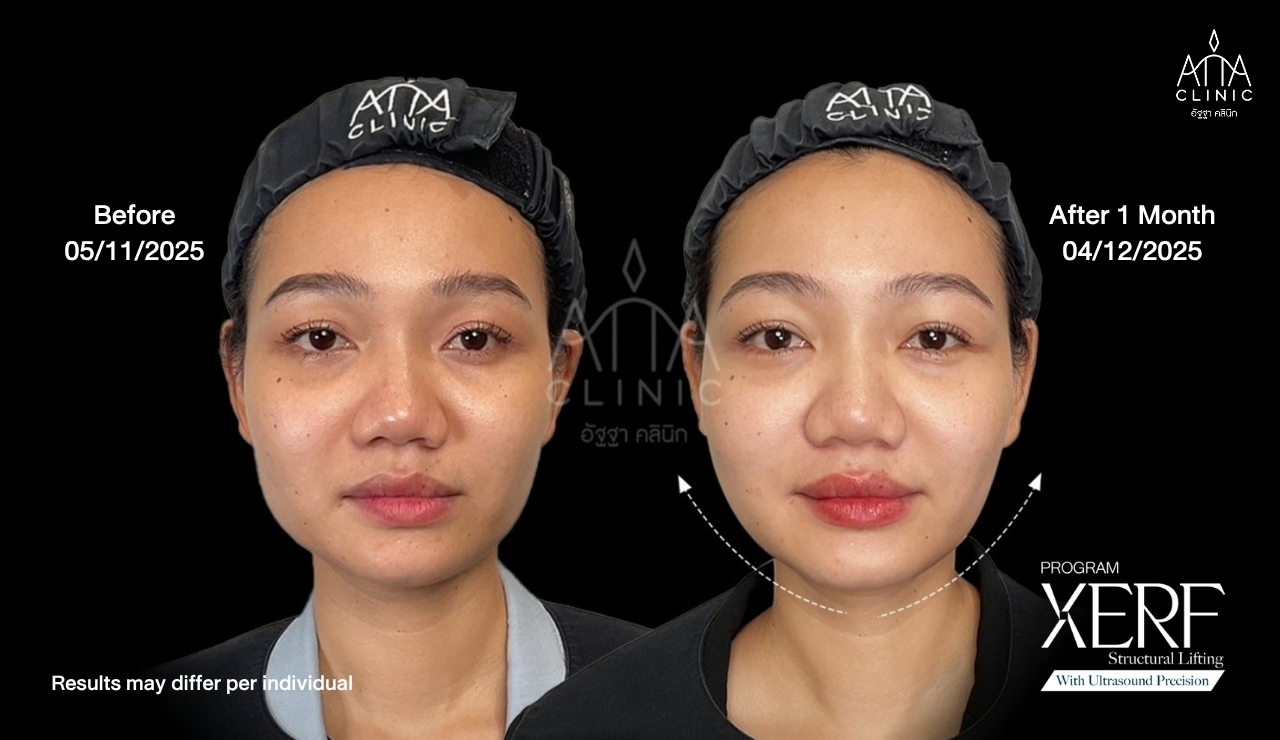 03-xerf-before-after-1-month-front.jpg
