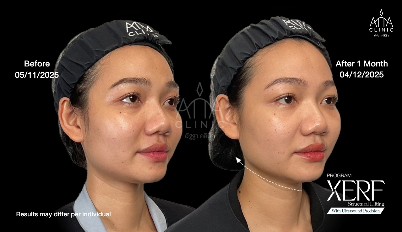 04-xerf-review-jawline-1-month.jpg