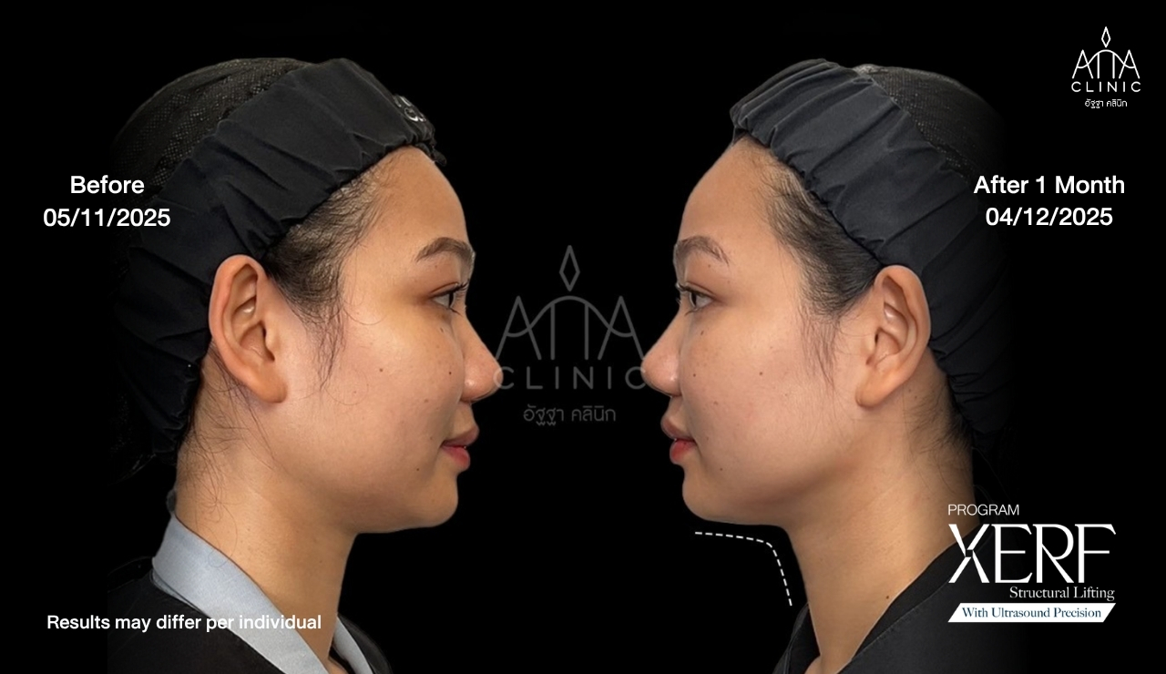 05-xerf-before-after-side-profile.jpg