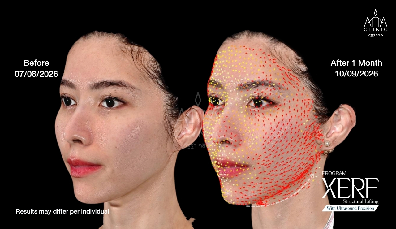 07-xerf-before-after-1-month-angle.jpg