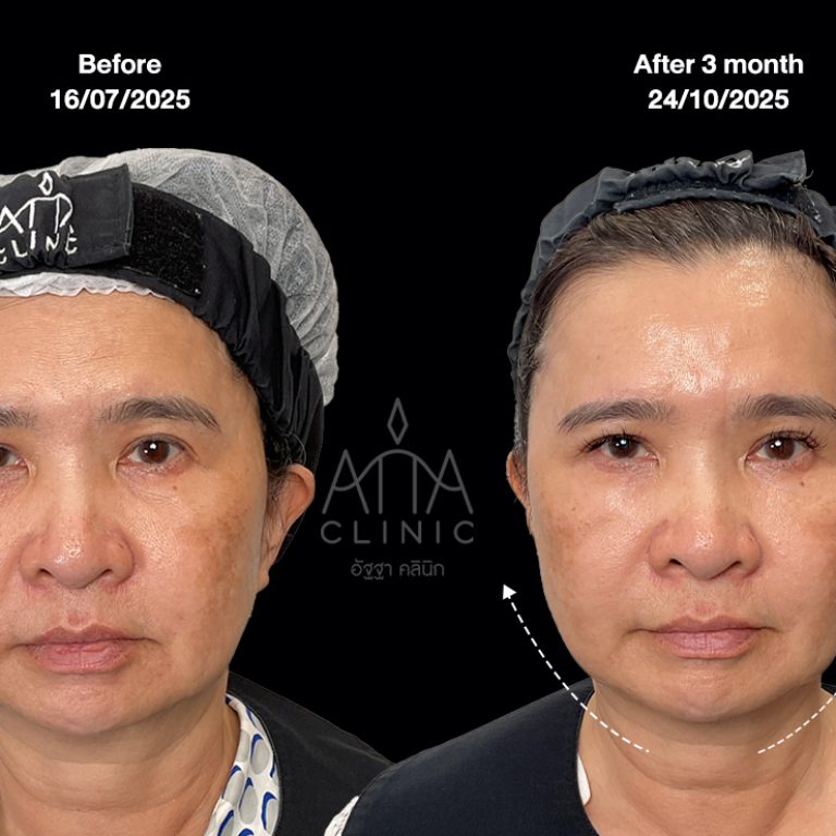 ผลลัพธ์โปรแกรม Endolift 3 เดือน