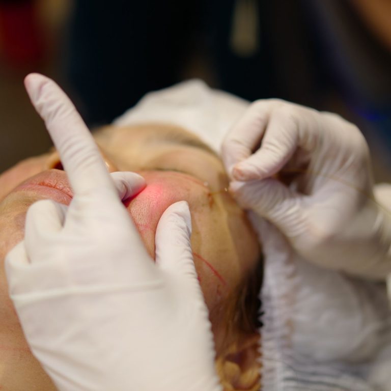 3-signs-need-endolift-ultrasound-facelift-01