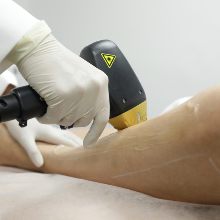 เลเซอร์กำจัดขนคือ ตอนทำเจ็บหรือไม่