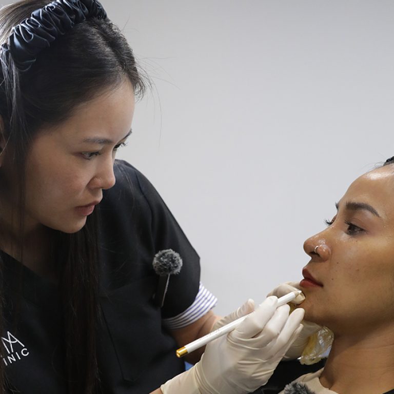 jawline-filler-facial-contouring-01