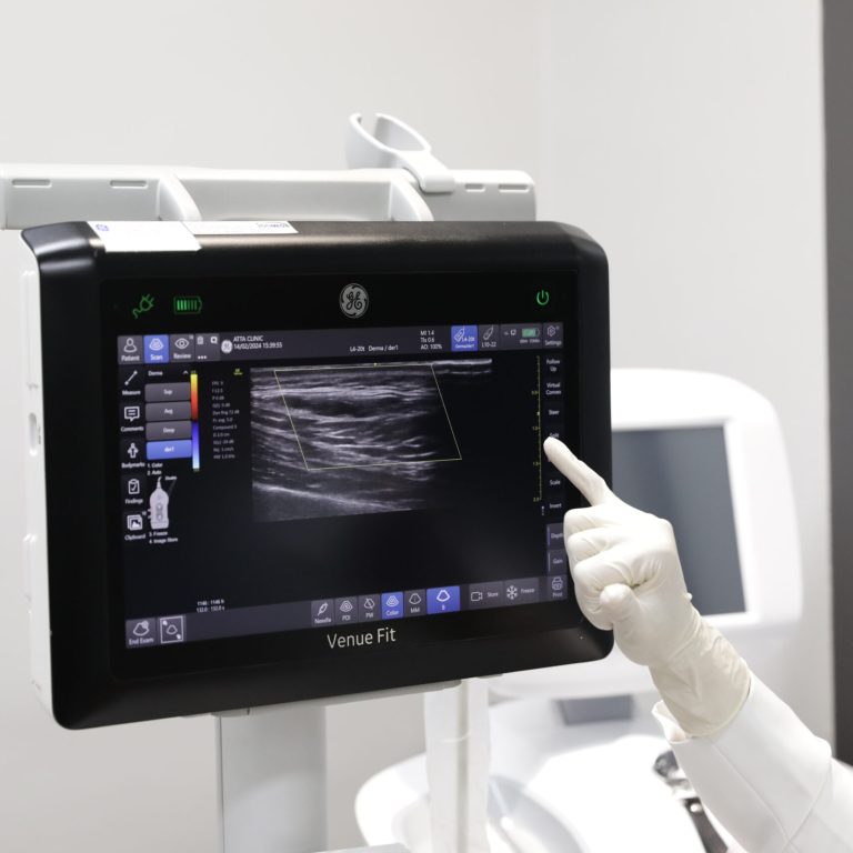 อัลตร้าซาวนด์ใบหน้า ฉีดฟิลเลอร์ ฟิลเลอร์ขมับ (2)